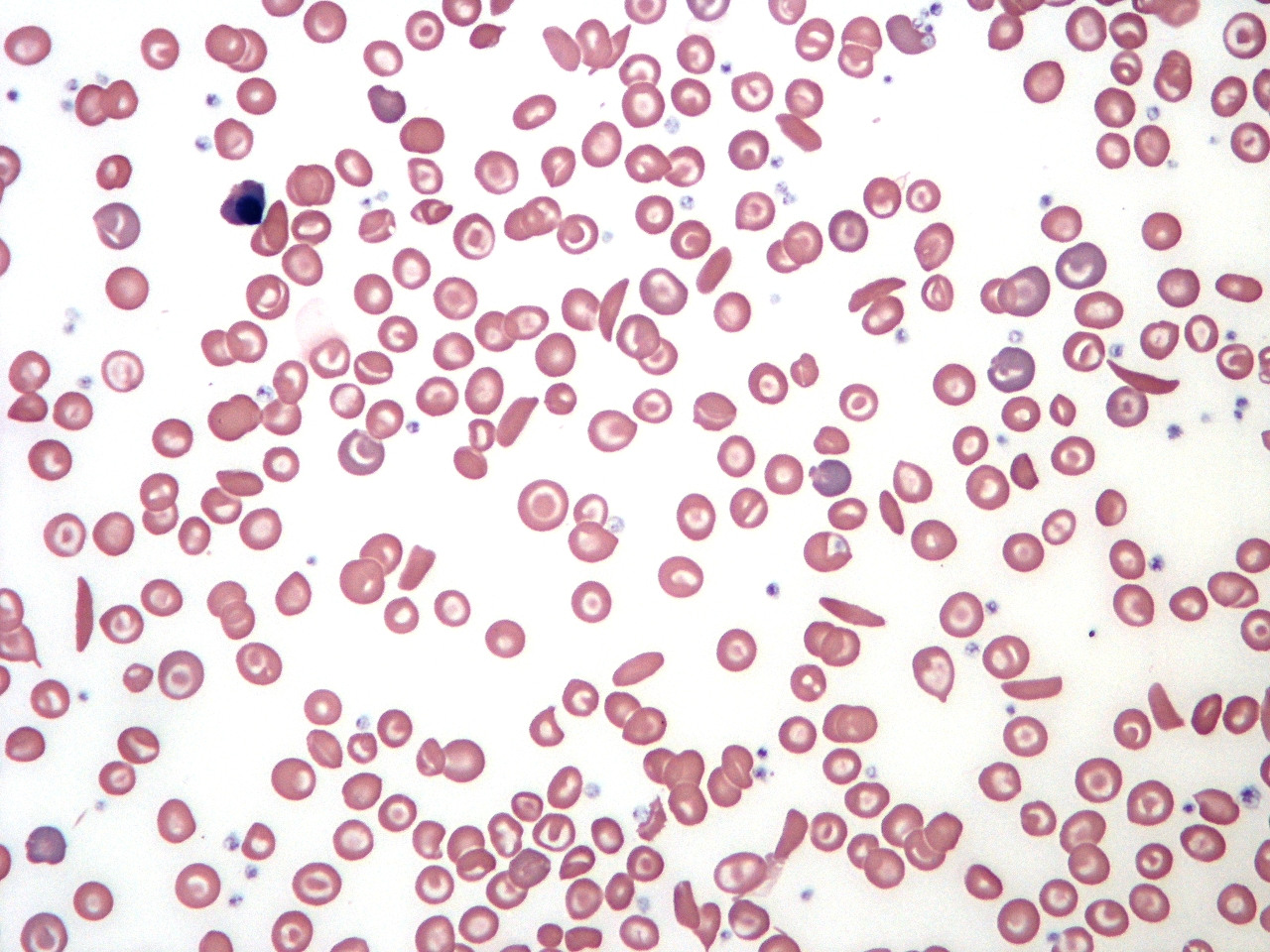 Blood-smear morphology